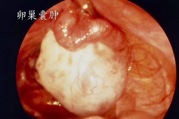 卵巢肿瘤是女性生殖器常见肿瘤