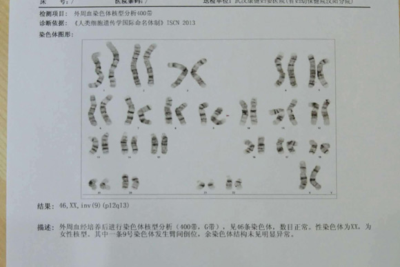 染色体异常导致了多次流产