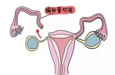 海南慈铭博鳌国际医院三代试管婴儿，切除双侧输卵管还能做试管婴儿吗？